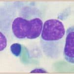 Zini_piattaforme_di-diagnosi_in ematologia_Figura_54