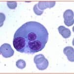 Zini_piattaforme_di-diagnosi_in ematologia_Figura_59