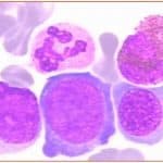 Zini_piattaforme_di-diagnosi_in ematologia_Figura_60