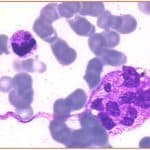 Zini_piattaforme_di-diagnosi_in ematologia_Figura_64