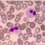 Zini_piattaforme_di-diagnosi_in ematologia_Figura_65